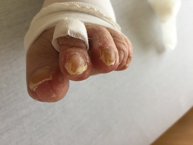 soin pedicure ongle après